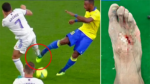 Hậu vệ Cadiz gãy 2 ngón chân sau pha kê gầm giày ghê rợn của Hazard